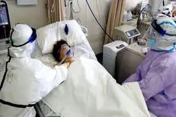 بیماران مبتلا به کرونا ممکن است دچار آسیب مغزی نیز شوند