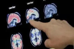 تشخیص زودهنگام آلزایمر با نشانگر عصبی جدید