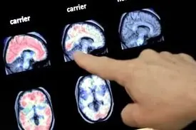 تشخیص زودهنگام آلزایمر با نشانگر عصبی جدید