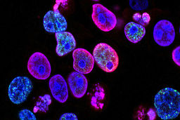 کشتن سرطان با آهن