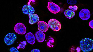 کشتن سرطان با آهن