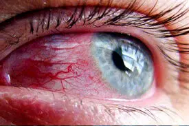 التهاب چشم یکی از نشانه‌های تهاجم کرونا است