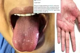 هشدار انگلیس درباره افزایش علائم مرتبط با ویروس کرونا در کودکان