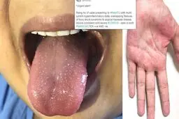 هشدار انگلیس درباره افزایش علائم مرتبط با ویروس کرونا در کودکان