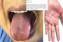 هشدار انگلیس درباره افزایش علائم مرتبط با ویروس کرونا در کودکان
