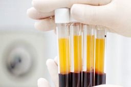 پلاسما درمانی تا ۶۰ درصد در درمان کرونا موثر است