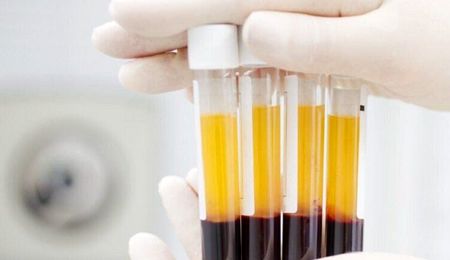 پلاسما درمانی تا ۶۰ درصد در درمان کرونا موثر است