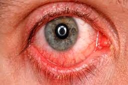 امکان ابتلا به کووید ۱۹ از راه چشم وجود دارد؟