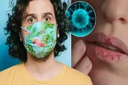 تغییرات عجیب لب‌‌ها بر اثر ابتلا به ویروس کرونا