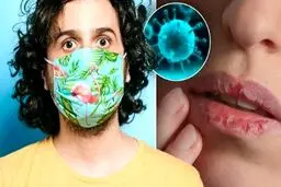 تغییرات عجیب لب‌‌ها بر اثر ابتلا به ویروس کرونا