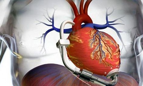 سندرم قلب شکسته در دوران همه‌گیری کرونا افزایش یافته است