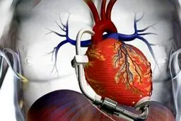 سندرم قلب شکسته در دوران همه‌گیری کرونا افزایش یافته است