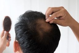 ۶ علت اصلی ریزش مو