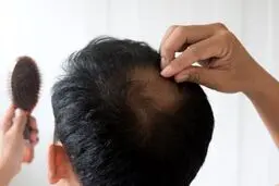 ۶ علت اصلی ریزش مو