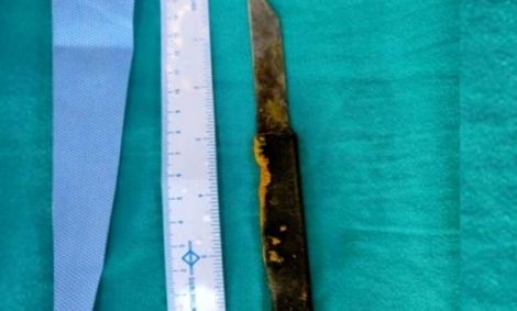 دور دنیا| خروج چاقوی ۲۰ سانتی از کبد مرد هندی جراحان را شگفت‌زده کرد+ عکس