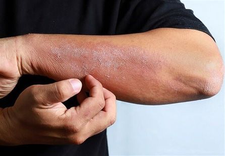 بلاهایی که کووید-۱۹ بر سر پوست می‌آورد