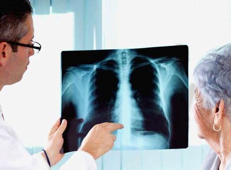 احتمال تاثیر یک دارو در جلوگیری از عفونت ریه هنگام ابتلا به کرونا