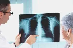 احتمال تاثیر یک دارو در جلوگیری از عفونت ریه هنگام ابتلا به کرونا