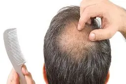 ریزش مو؛ عارضه طولانی‌مدت ابتلا به کرونا