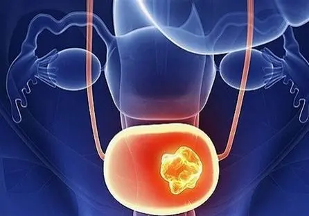 کاهش عفونت‌های جنسی در دوران شیوع کرونا