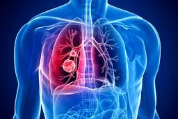 پیوند ریه از اهدا کننده زنده به بیمار کرونایی