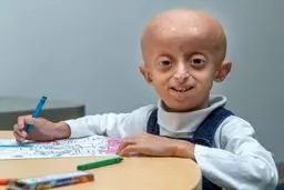 دختربچه ۱۰ ساله بر اثر پیری درگذشت + عکس