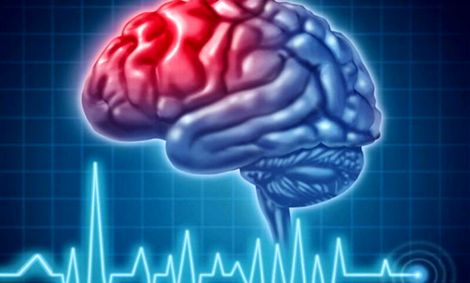 سالانه ۱۸۰ هزار نفر در کشور دچار سکته مغزی می‌شوند