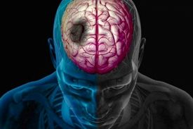 پیش بینی احتمال سکته مغزی ۱۰ سال قبل از وقوع!