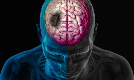 پیش بینی احتمال سکته مغزی ۱۰ سال قبل از وقوع!