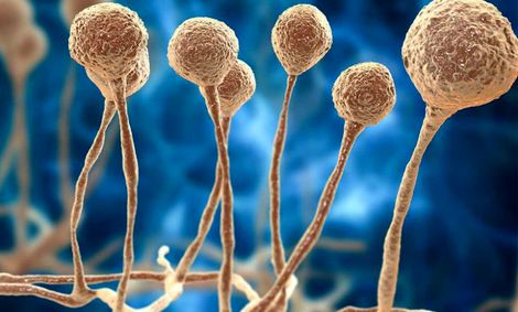 نخستین بیمار مبتلا به قارچ سیاه در نیشابور شناسایی شد