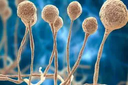 نخستین بیمار مبتلا به قارچ سیاه در نیشابور شناسایی شد