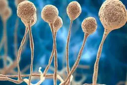 نخستین بیمار مبتلا به قارچ سیاه در نیشابور شناسایی شد