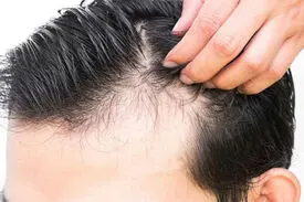 کرونا و معمای ریزش موی سر