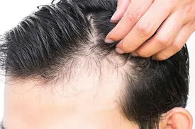 کرونا و معمای ریزش موی سر