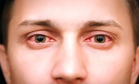 قارچ سیاه، یک عفونت قارچی جدی