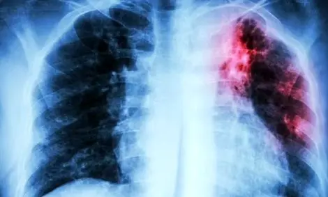 افزایش مرگ و میر جهانی سل برای اولین بار در ۱۵ سال گذشته