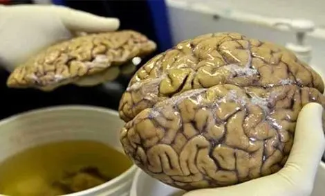 کرونا و زوال عقل!