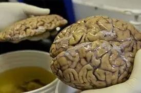 کرونا و زوال عقل!