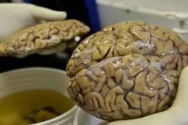 کرونا و زوال عقل!