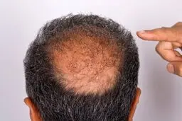 تاسی به عوارض کرونا اضافه شد!