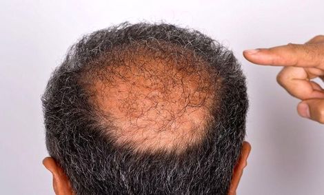 تاسی به عوارض کرونا اضافه شد!