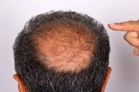 تاسی به عوارض کرونا اضافه شد!