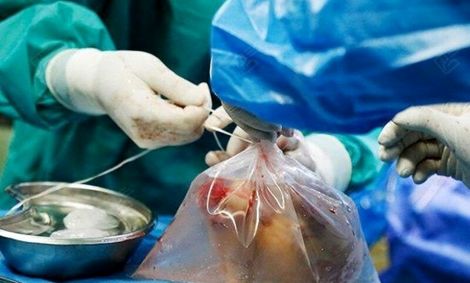 دختر یکساله هرمزگانی زندگی بخش چهار نفر شد