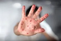 خطر شیوع سرخک در ایران؛ چرا این بیماری به وضعیت هشدار رسید؟