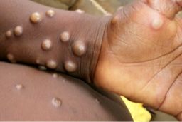ابتلای ۸۰ نفر در ۱۲ کشور به آبله میمون تایید شد