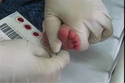 جزئیات غربالگری کم‌کاری تیروئید در نوزادان