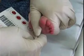 جزئیات غربالگری کم‌کاری تیروئید در نوزادان