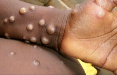 وزارت بهداشت: «آبله میمونی» هنوز به ایران نرسیده است