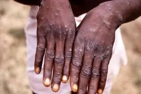 نام آبله میمون تغییرمیکند؟