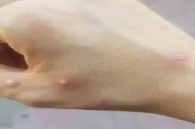 تصاویر ضایعه پوستی اولین بیمار مبتلا آبله میمونی در ایران/ نکات مهمی که باید درباره آبله میمونی بدانیم